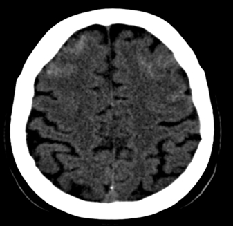 Slika 1. Nativna CT-preiskava, kjer je obojestransko frontalno vidna kSAK.