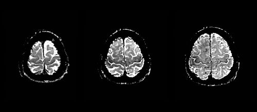 Slika 2. Susceptibilno poudarjeno slikanje (SWI) avgusta 2017 na MR tomografu jakosti 3 T: v poteku primarne motorične skorje je bil signal obojestransko simetrično znižan.